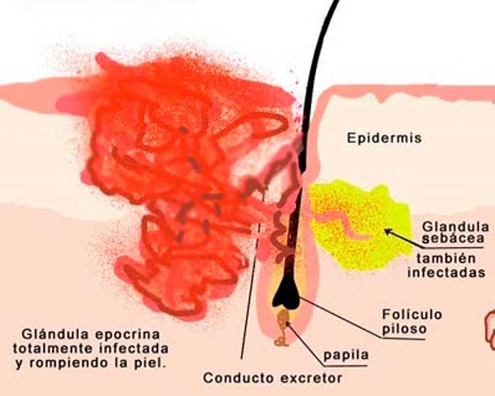 Hidradenitis supurativa: dolor, vergüenza y tabú