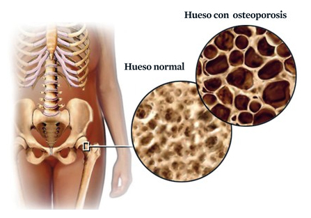 La relación entre osteoporosis y diabetes